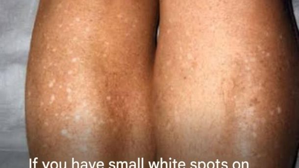 Small White Spots on Your Arms or Legs: What They Could Mean and When to See a Doctor